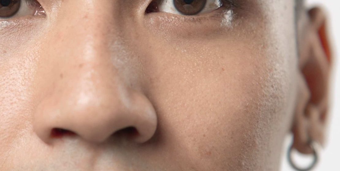 Medical face peel