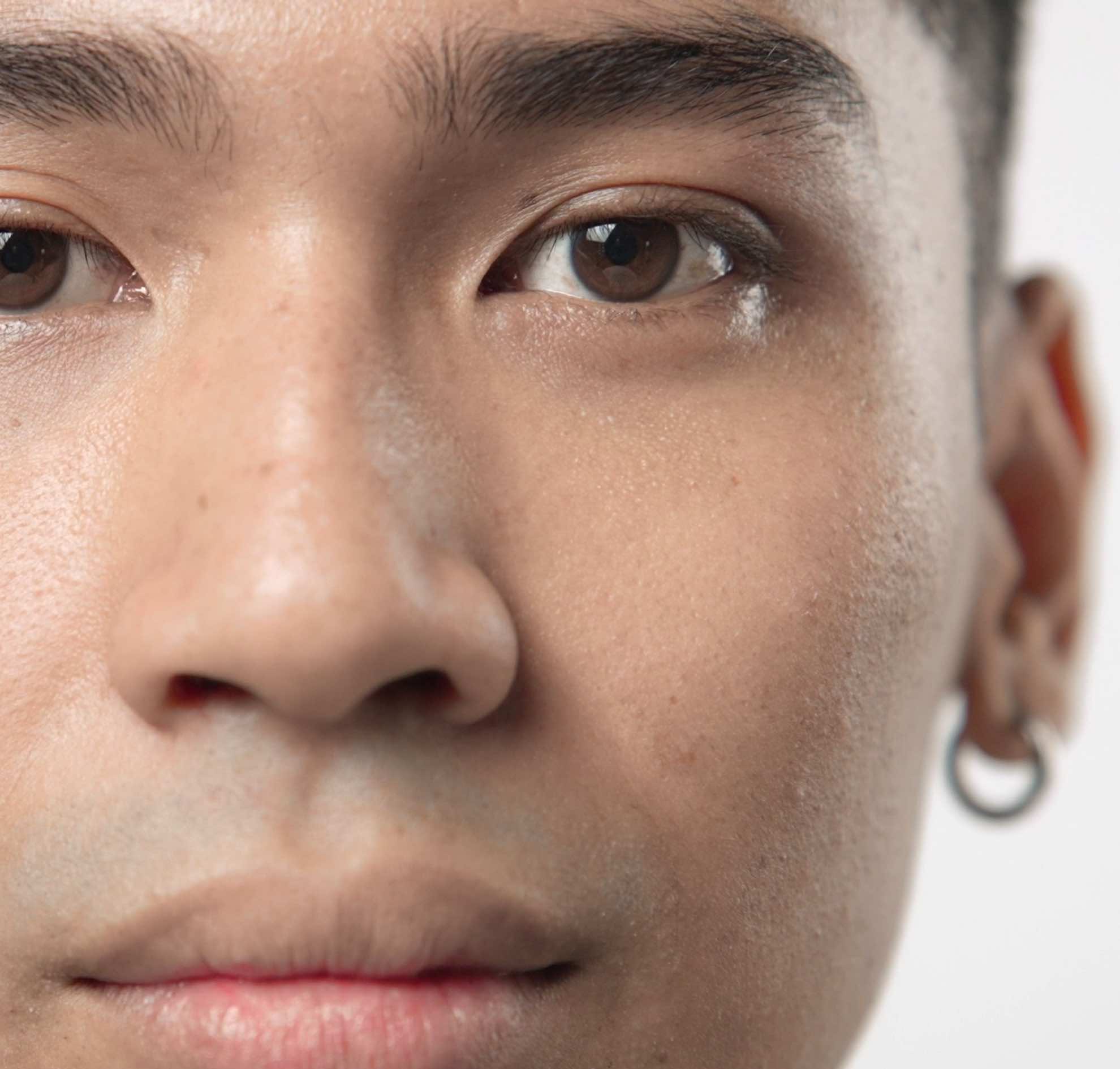 Medical face peel