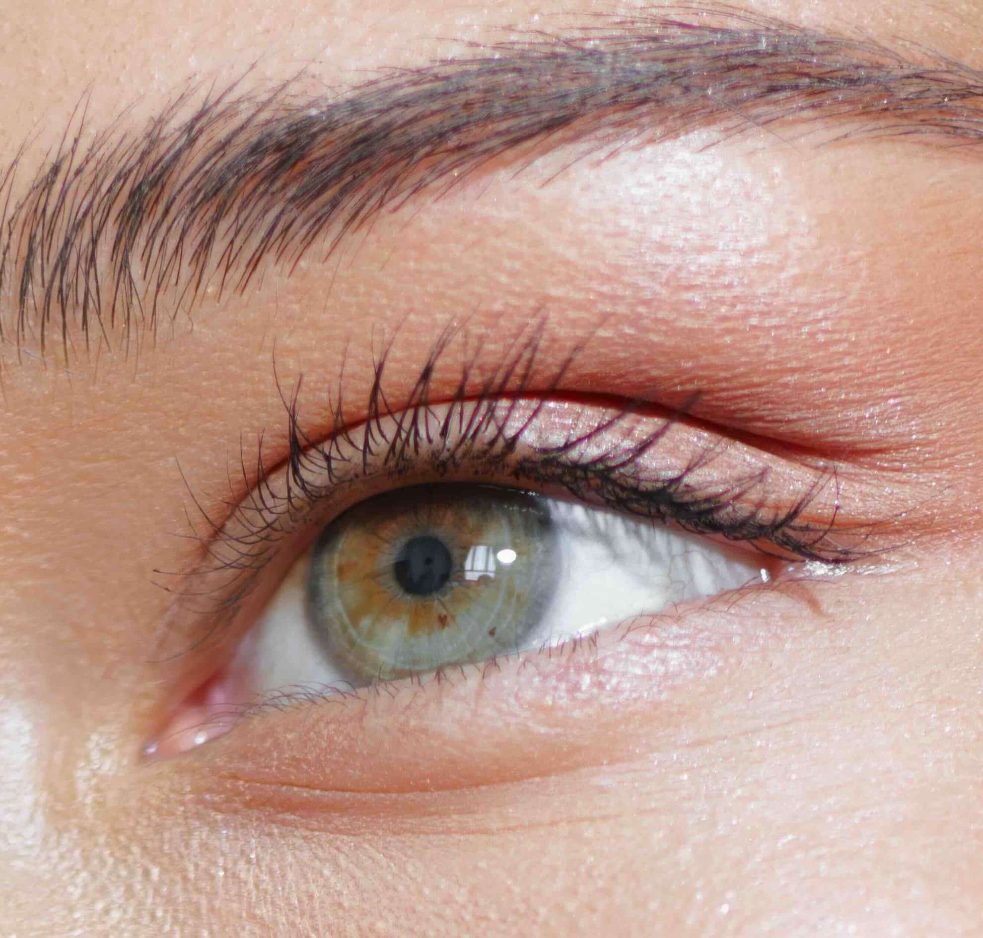 Blepharoplasty